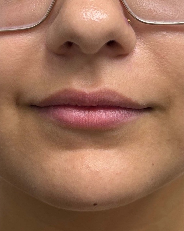 Juvederm Before & After Image