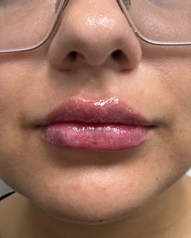 Juvederm Before & After Image