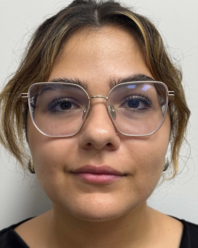 Juvederm Before & After Image