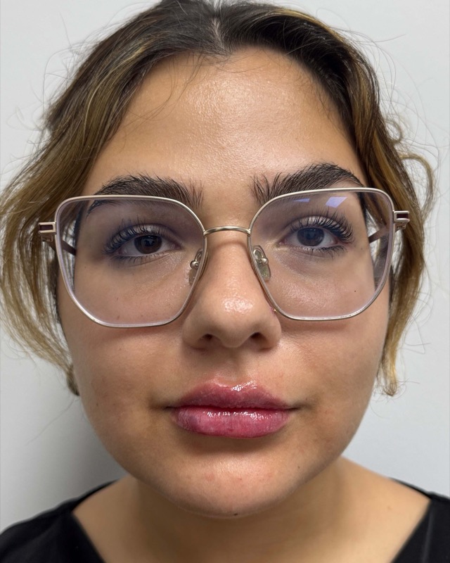 Juvederm Before & After Image