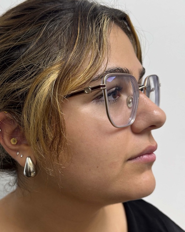 Juvederm Before & After Image