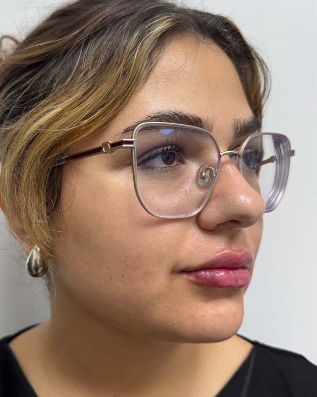 Juvederm Before & After Image