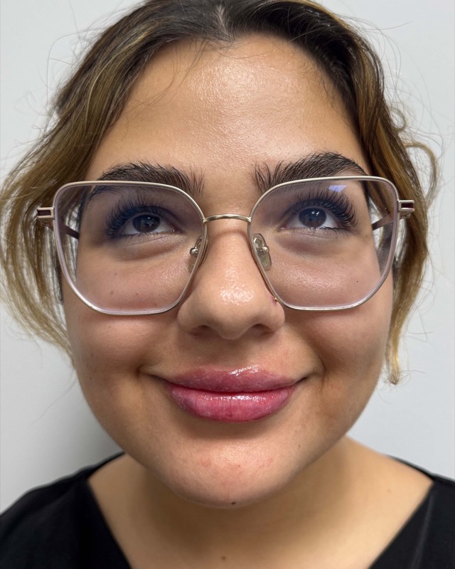 Juvederm Before & After Image