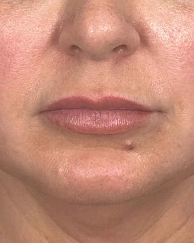 Juvederm Before & After Image