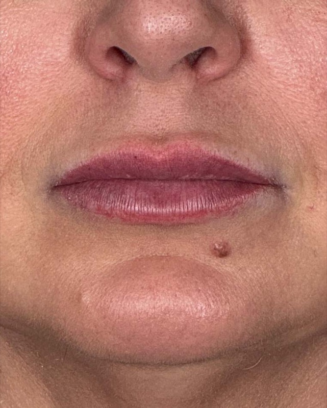 Juvederm Before & After Image