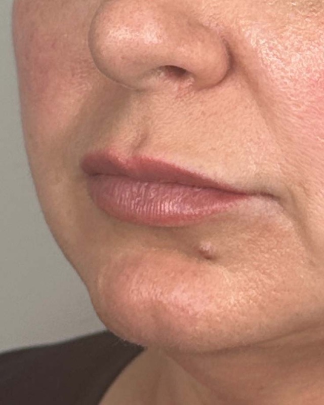 Juvederm Before & After Image