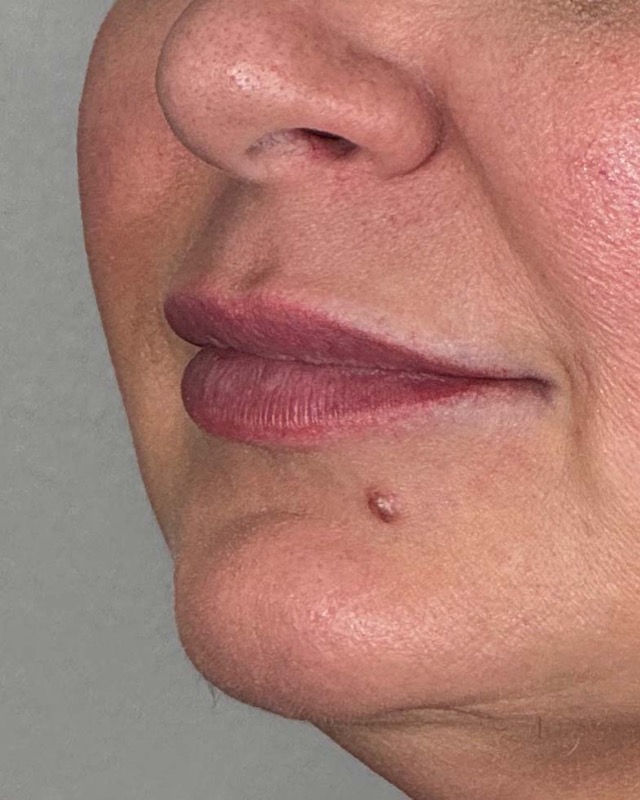 Juvederm Before & After Image