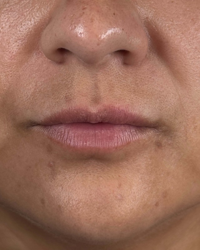 Juvederm Before & After Image