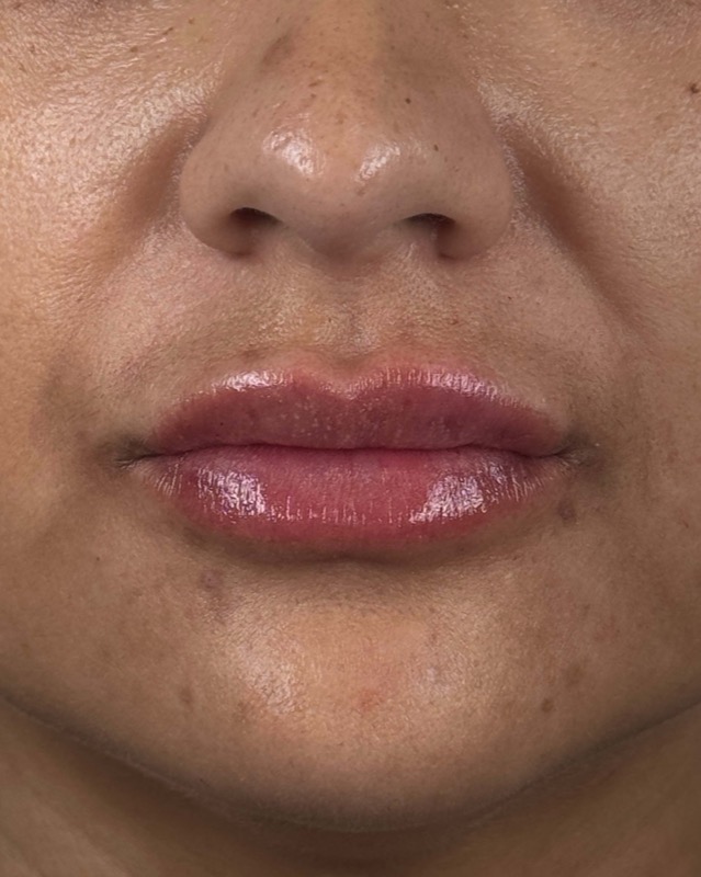 Juvederm Before & After Image