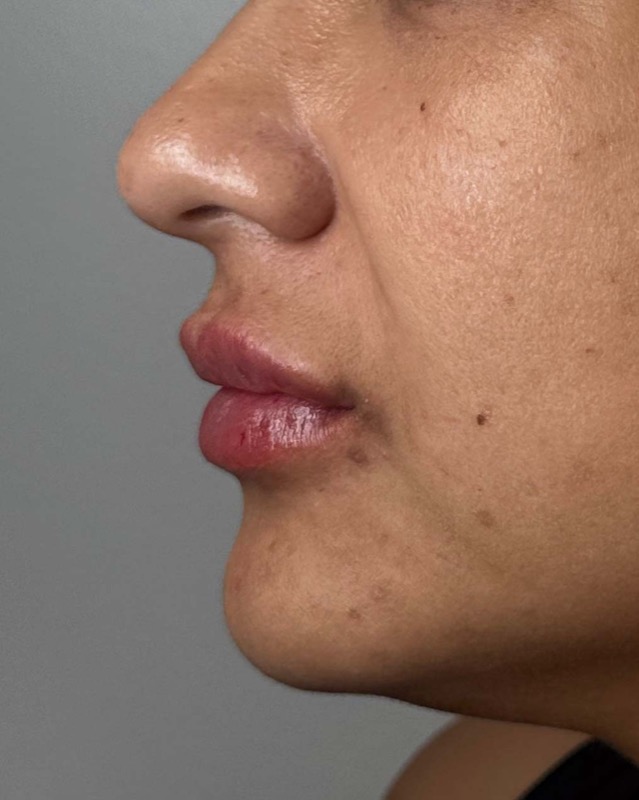 Juvederm Before & After Image