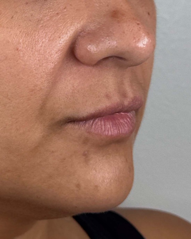 Juvederm Before & After Image