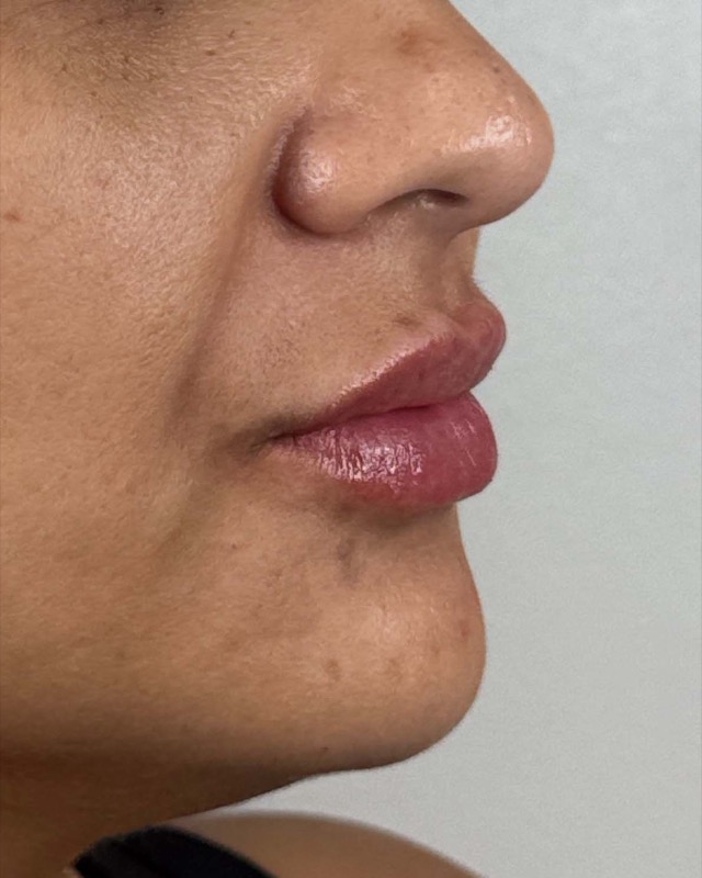 Juvederm Before & After Image