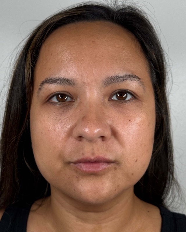 Juvederm Before & After Image