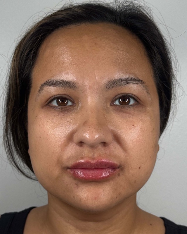Juvederm Before & After Image