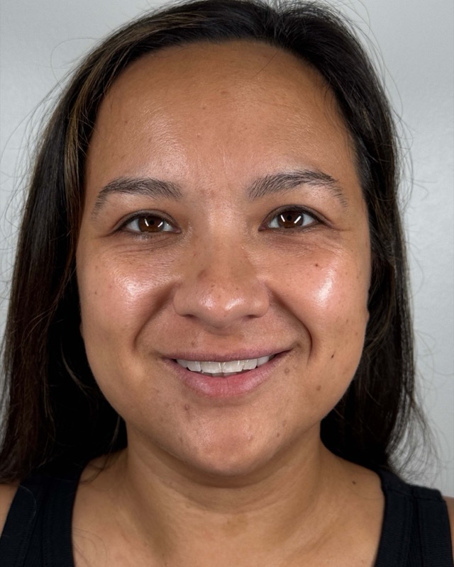 Juvederm Before & After Image