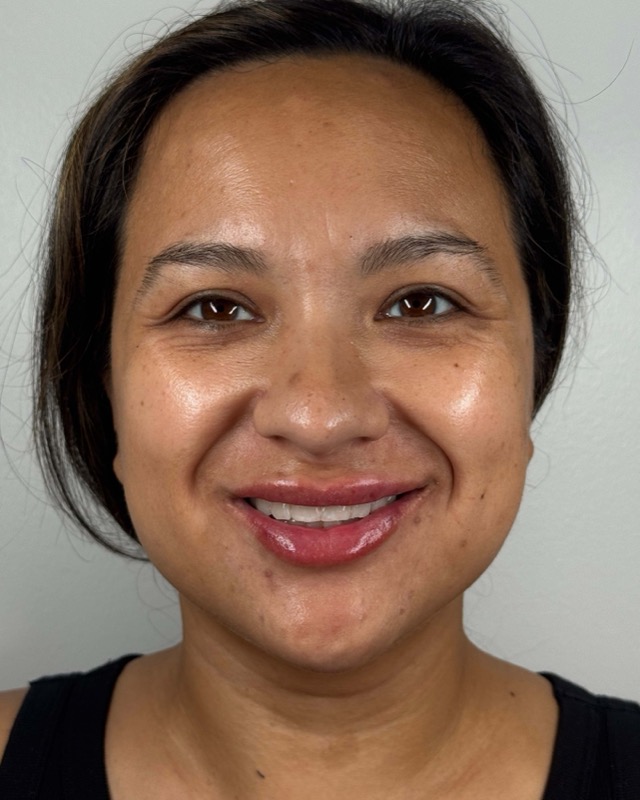 Juvederm Before & After Image