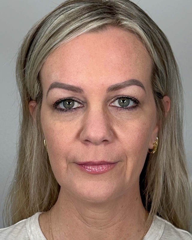 Juvederm Before & After Image