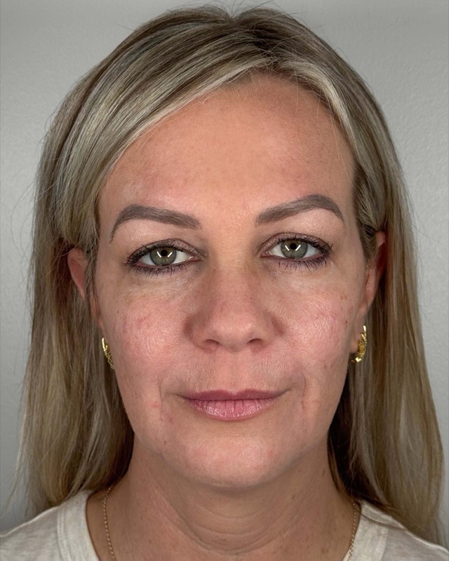 Juvederm Before & After Image