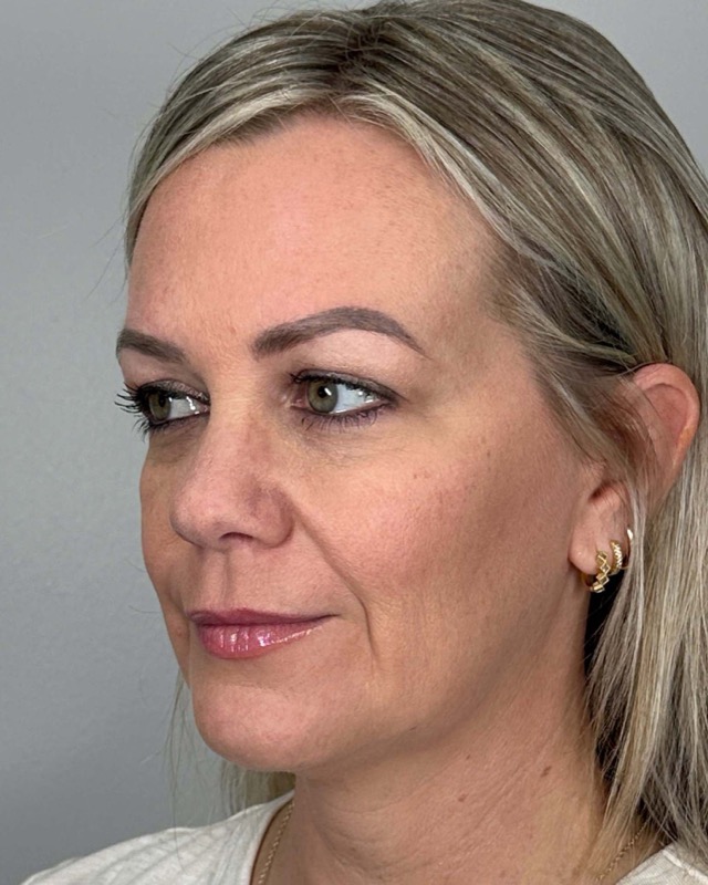 Juvederm Before & After Image