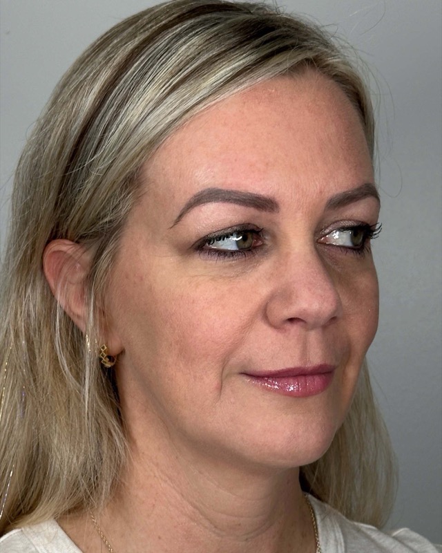 Juvederm Before & After Image