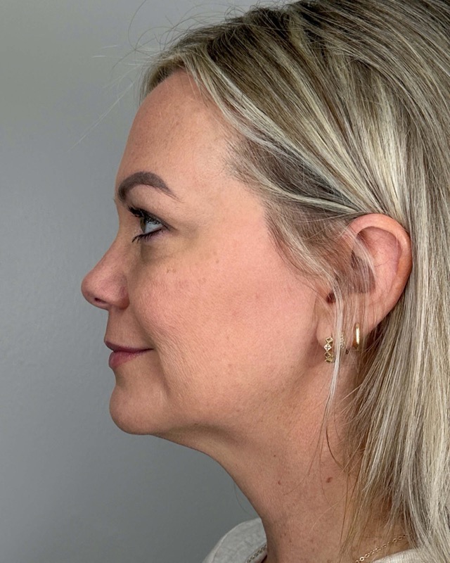 Juvederm Before & After Image