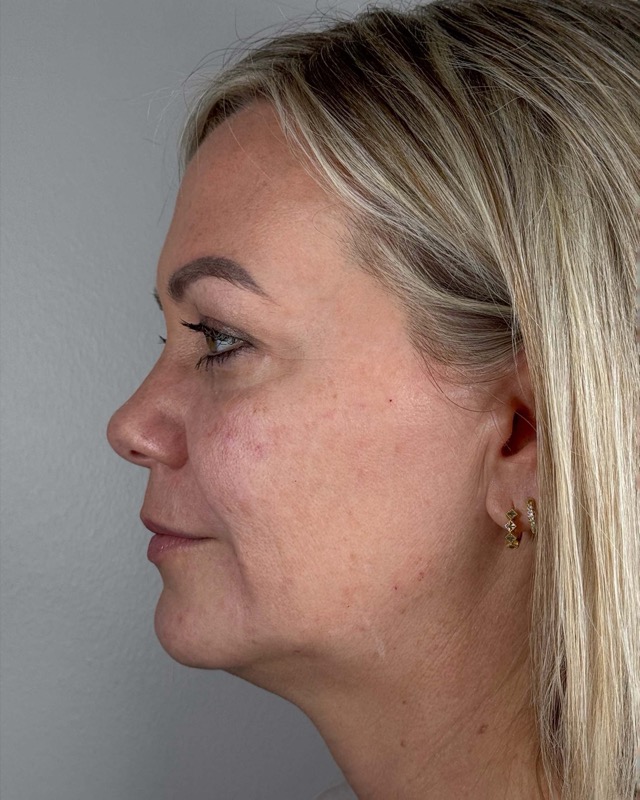 Juvederm Before & After Image