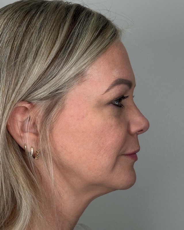 Juvederm Before & After Image