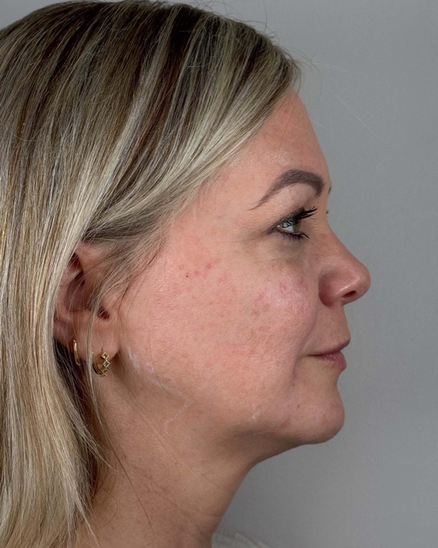 Juvederm Before & After Image