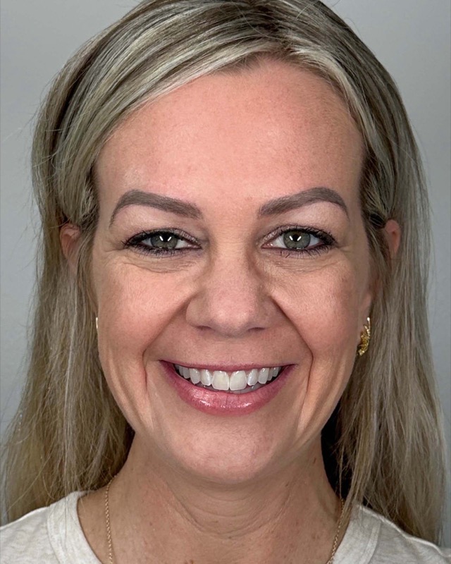 Juvederm Before & After Image