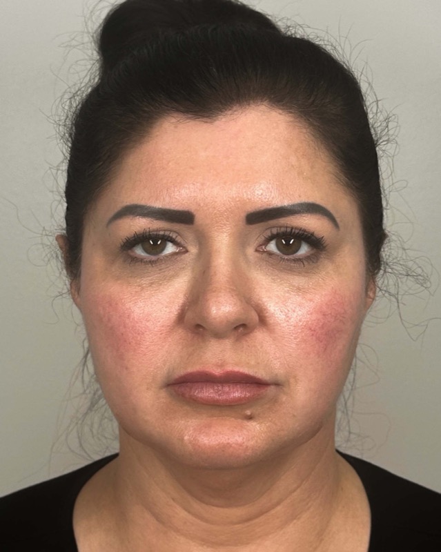 Juvederm Before & After Image