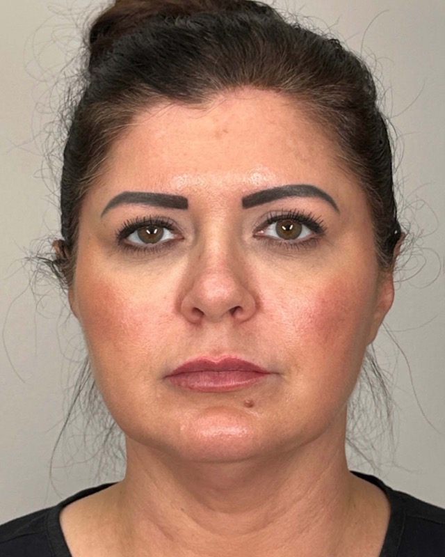 Juvederm Before & After Image