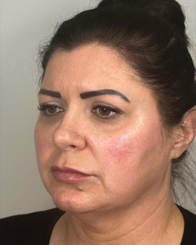 Juvederm Before & After Image