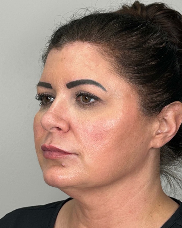 Juvederm Before & After Image