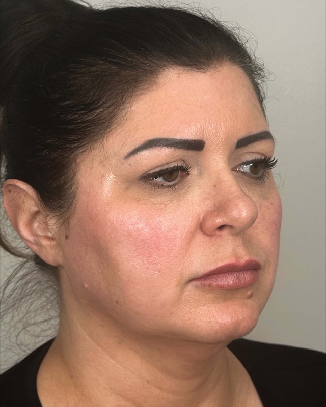 Juvederm Before & After Image