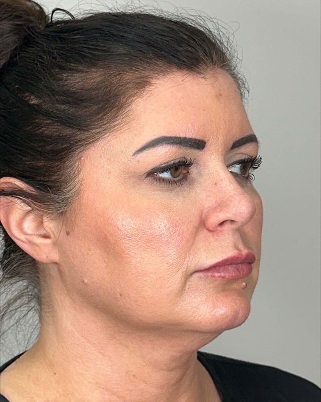 Juvederm Before & After Image