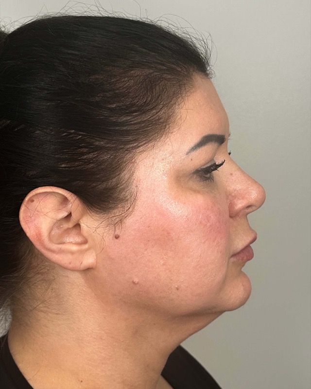 Juvederm Before & After Image