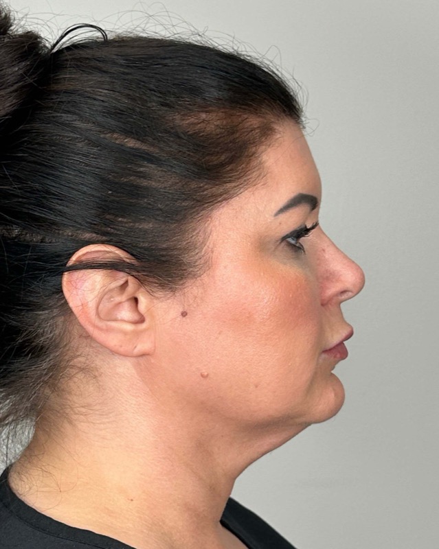 Juvederm Before & After Image