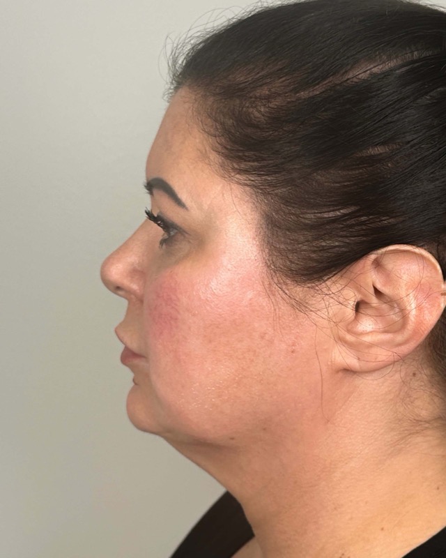 Juvederm Before & After Image