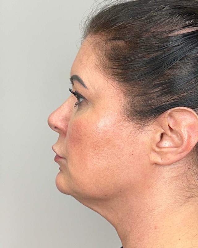 Juvederm Before & After Image