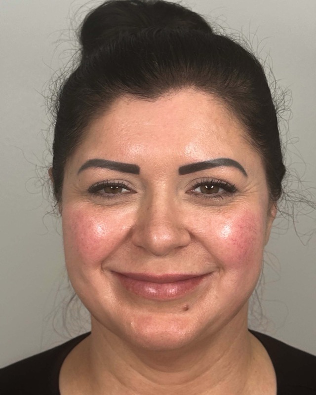 Juvederm Before & After Image