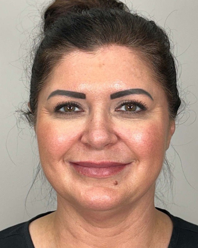 Juvederm Before & After Image