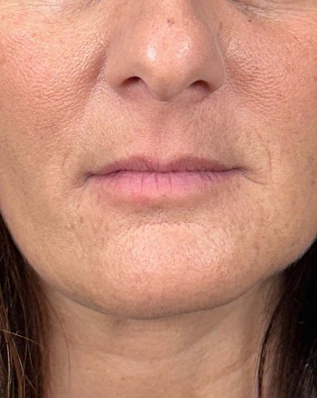 Juvederm Before & After Image