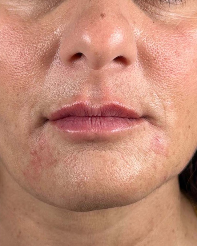 Juvederm Before & After Image