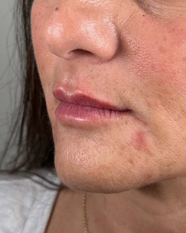 Juvederm Before & After Image