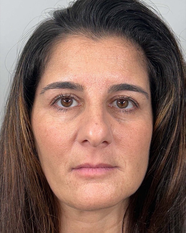 Juvederm Before & After Image