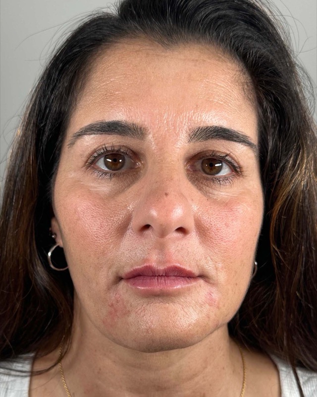 Juvederm Before & After Image