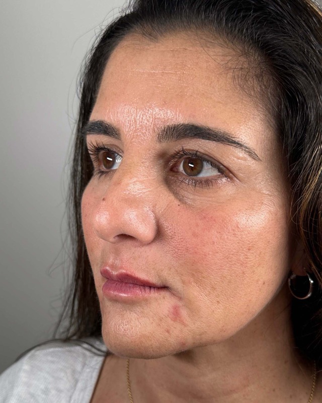 Juvederm Before & After Image