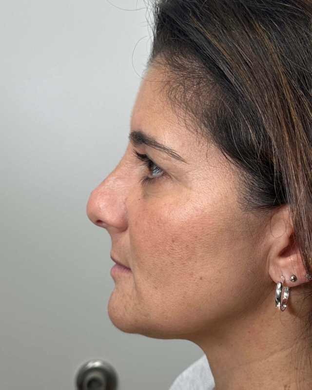 Juvederm Before & After Image