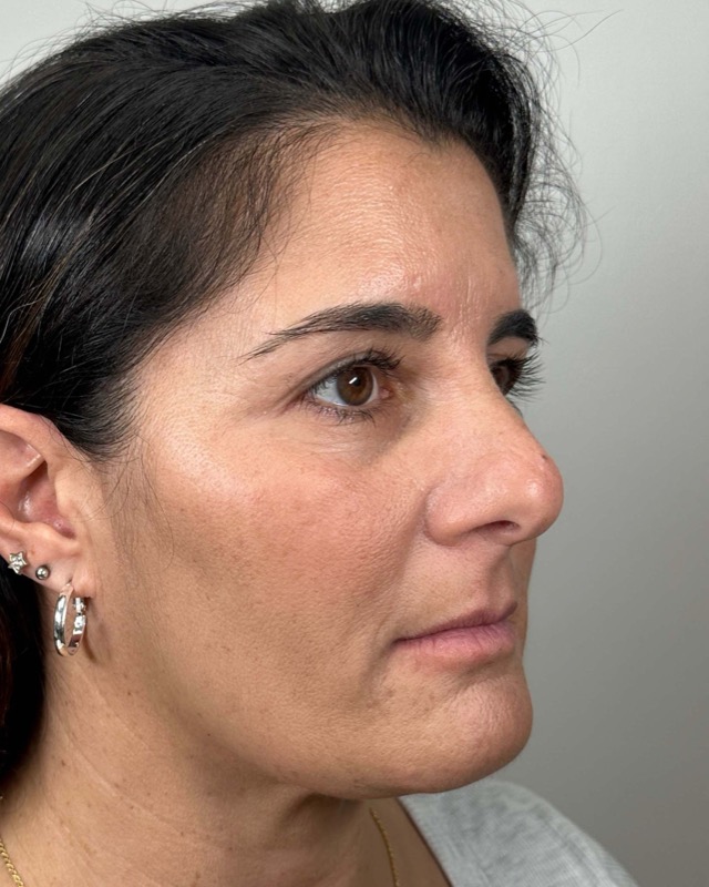 Juvederm Before & After Image