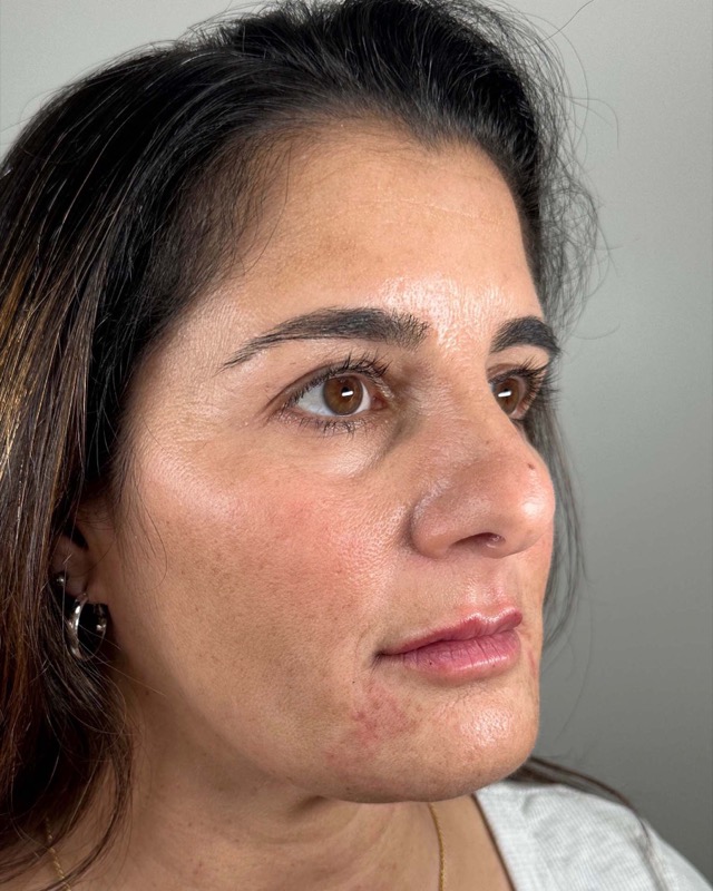 Juvederm Before & After Image